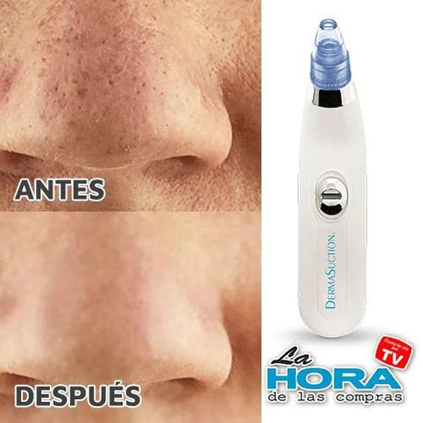 DermaSuction® - Extractor de espinillas y puntos negros